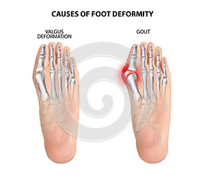 Causes of foot deformity. photo